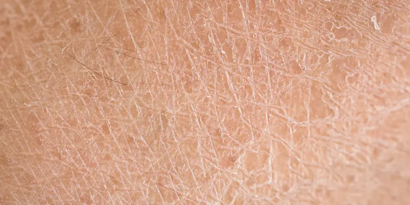 Skin 101 : All You Need to Know About Skin Health-dryness
